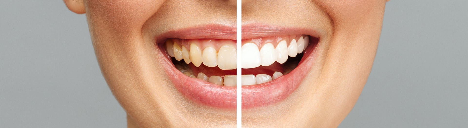 Teeth Whitening